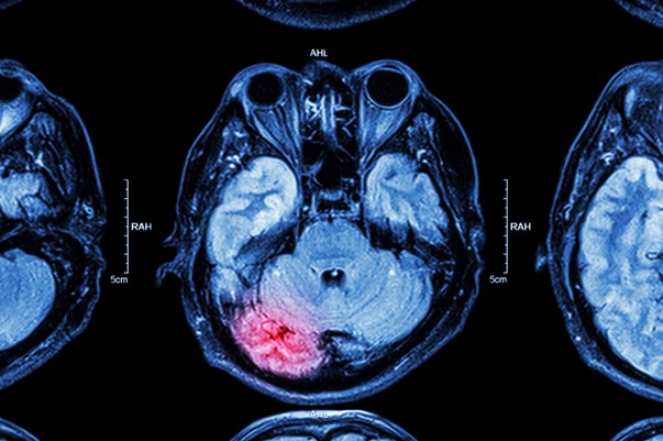 MRI of brain : brain injury